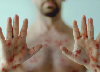 SSa confirma caso de viruela símica subclado Ib en México